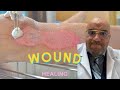 لماذا لا تلتئم الجروح المزمنة الأعداء الخفية للشفاء أسرار التئام الجروح    
