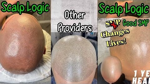 Botched SMP vs Subtle Pigmentation | The Truth