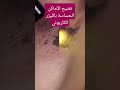 تفتيح الأماكن الحساسة بالليزر الكاربوني تفتيح الأماكن الحساسة الليزر Hollywood Peel اكسبلور 