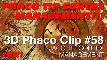 3D Phaco Clip #58 - Phaco Tip Cortex Management (VR Headset Version)