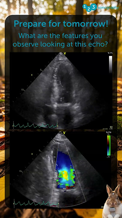 What are the features you observe looking at this patient's echo?