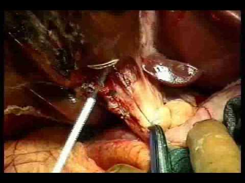 08 Inflow Control Pedicle Ligation, Right Pedicle