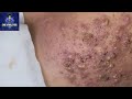 Cystic acne treatment  cyst and blackhead extraction  pimple popping clogged pores 3 treatment 2