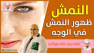 ظهور النمش في الوجه - وصفات طبيعية للتخلص من النمش من عند الدكتور عماد ميزاب Dr imad mizab