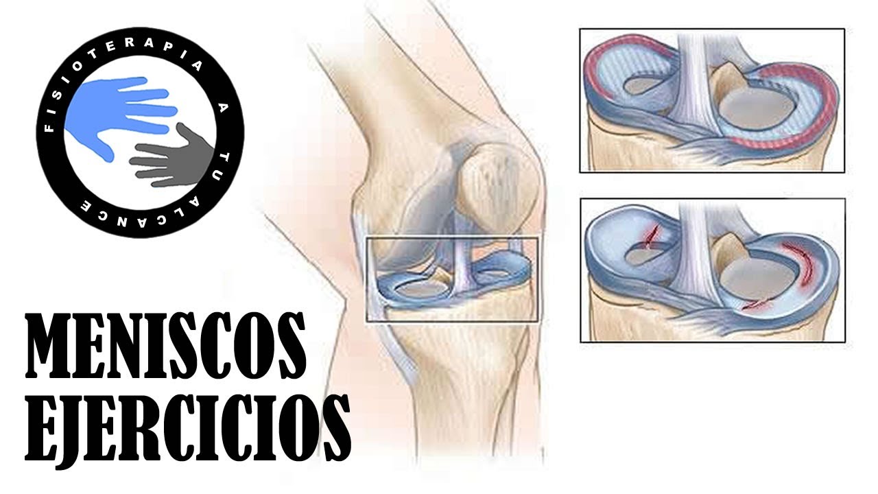 Ejercicios para meniscos inflamados