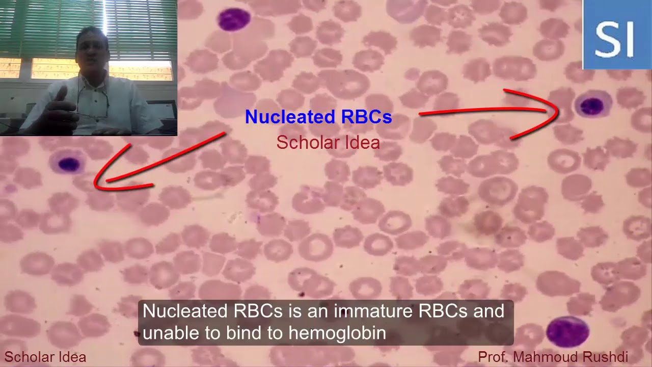 Nucleated red cells in the circulation !!! YouTube