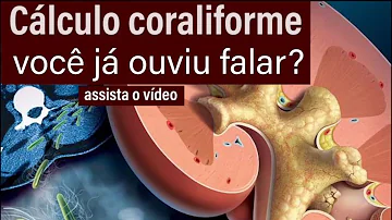 O que pode causar cálculo Coraliforme?