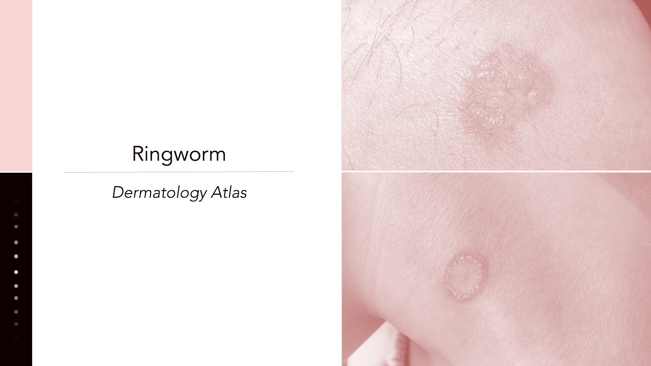 Ringworm