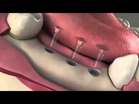dental-implants-procedure---lakeway-center-for-cosmetic-and-family-dentistry