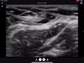 Ultrasound-Guided Intercostobrachial Nerve Block: Step-by-Step Guide for Upper Limb Anesthesia