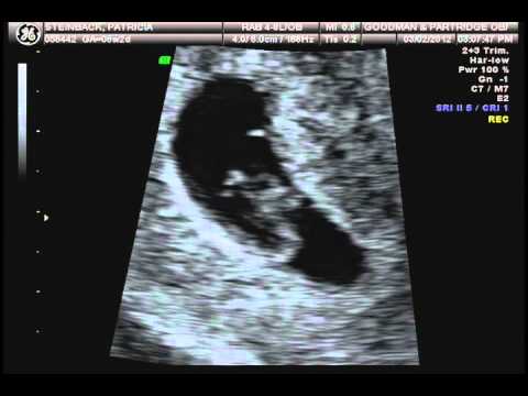 heartbeat at 7 weeks heartbeat at 7 weeks