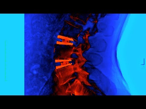 My Back Surgery at ONZ in Germany - 1 Year Later