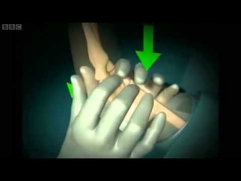 طبيب سوداني يخترع تقنية مبتكرة لعلاج الكسور