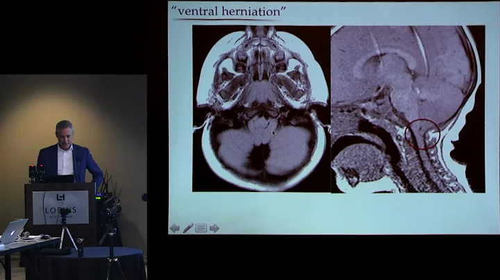 "Defining Unique Chiari Classifications" - Jeffrey...