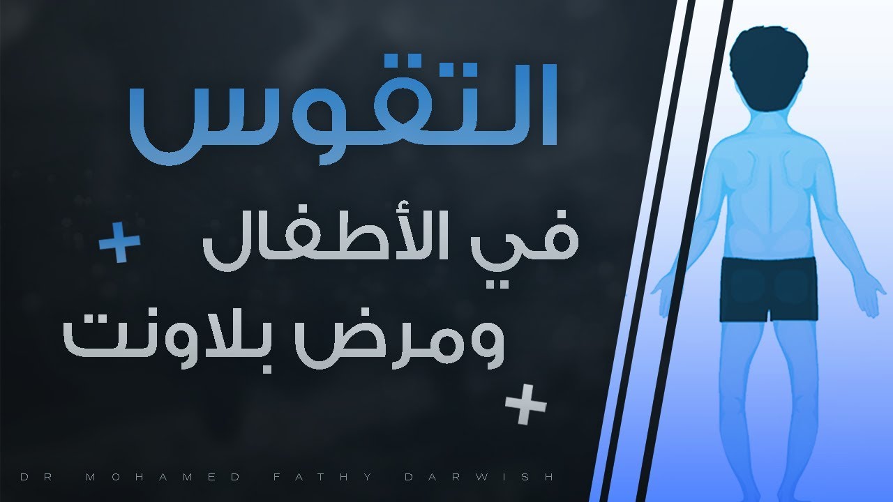 علاج تقوس الساقين فى الاطفال بدون جراحه