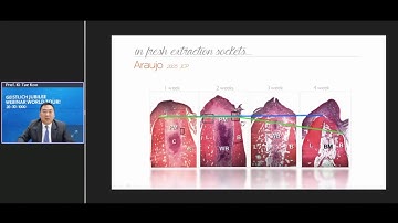 Geistlich Webinar Ridge Preservation - Dr  Ki Tae Koo