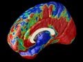 Imaging Alzheimer's in the Brain