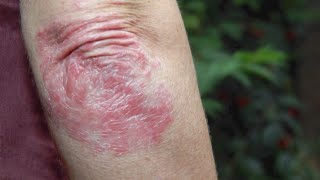 Wear The Gown: Battling stubborn plaque psoriasis