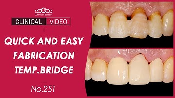 Quick and Easy fabrication of Temporary bridge - [Dr. Na Kiwon]