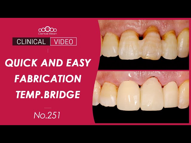 Quick and Easy fabrication of Temporary bridge - [Dr. Na Kiwon