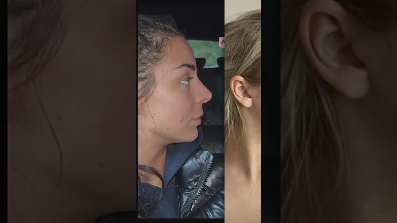 Pall Mall Rhinoplasty Patients