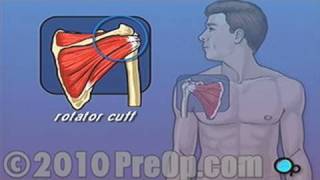 Rotator Cuff Repair Open Surgery PreOp® Patient Education