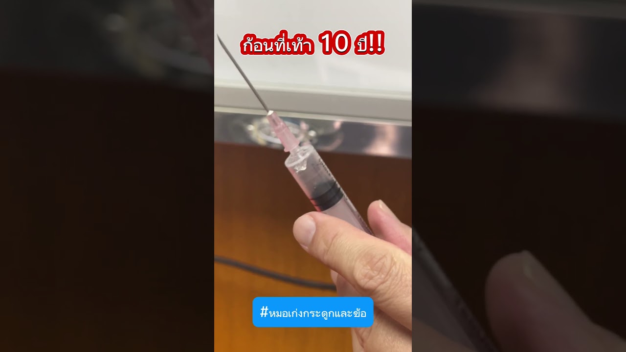 ก้อนที่เท้า 10 ปี !!! #หมอเก่งกระดูกและข้อ #ก้อน #ถุงน้ำ