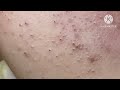 Super blackheads hoangmyspa24