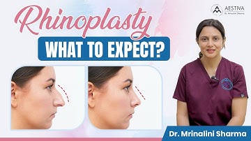 Rhinoplasty FAQ: What to Expect? | Results, Recovery, Precautions after Rhinoplasty - Aestiva Clinic
