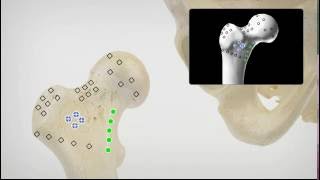 Robotic/Computer Assisted Hip Replacement