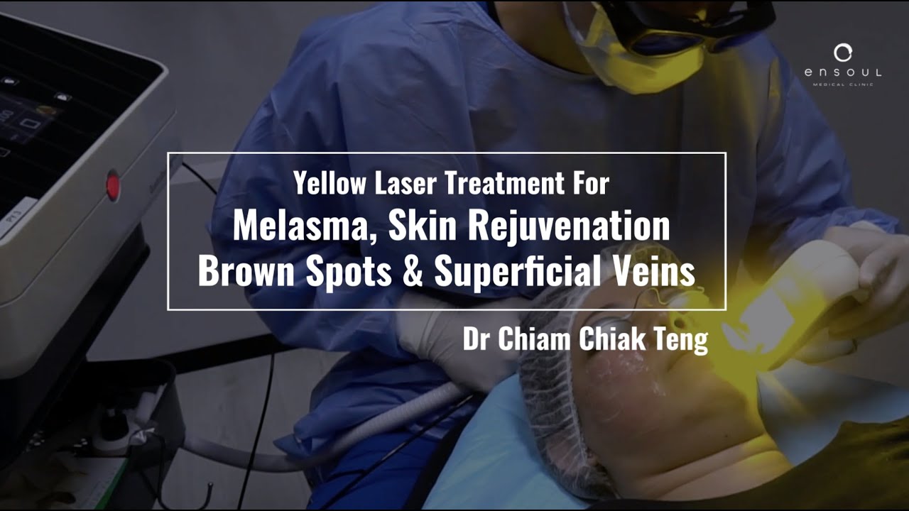 Yellow Laser Treatment for Melasma, Skin Rejuvenation, Brown Spots and Superficial Veins
