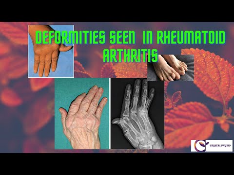 different deformities seen in rheumatoid arthritis