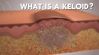 What Is A Keloid?