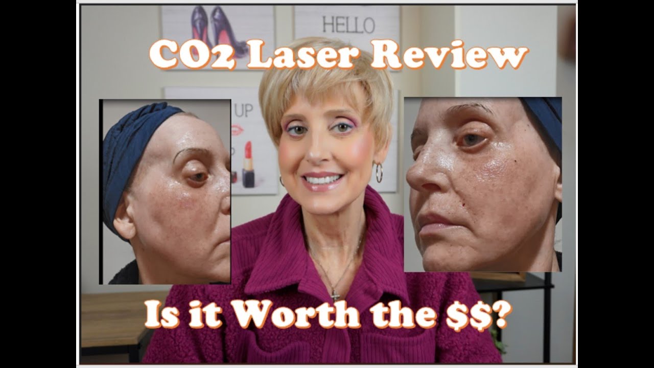 CO2 Laser Resurfacing Review! Is it Worth the $$$!