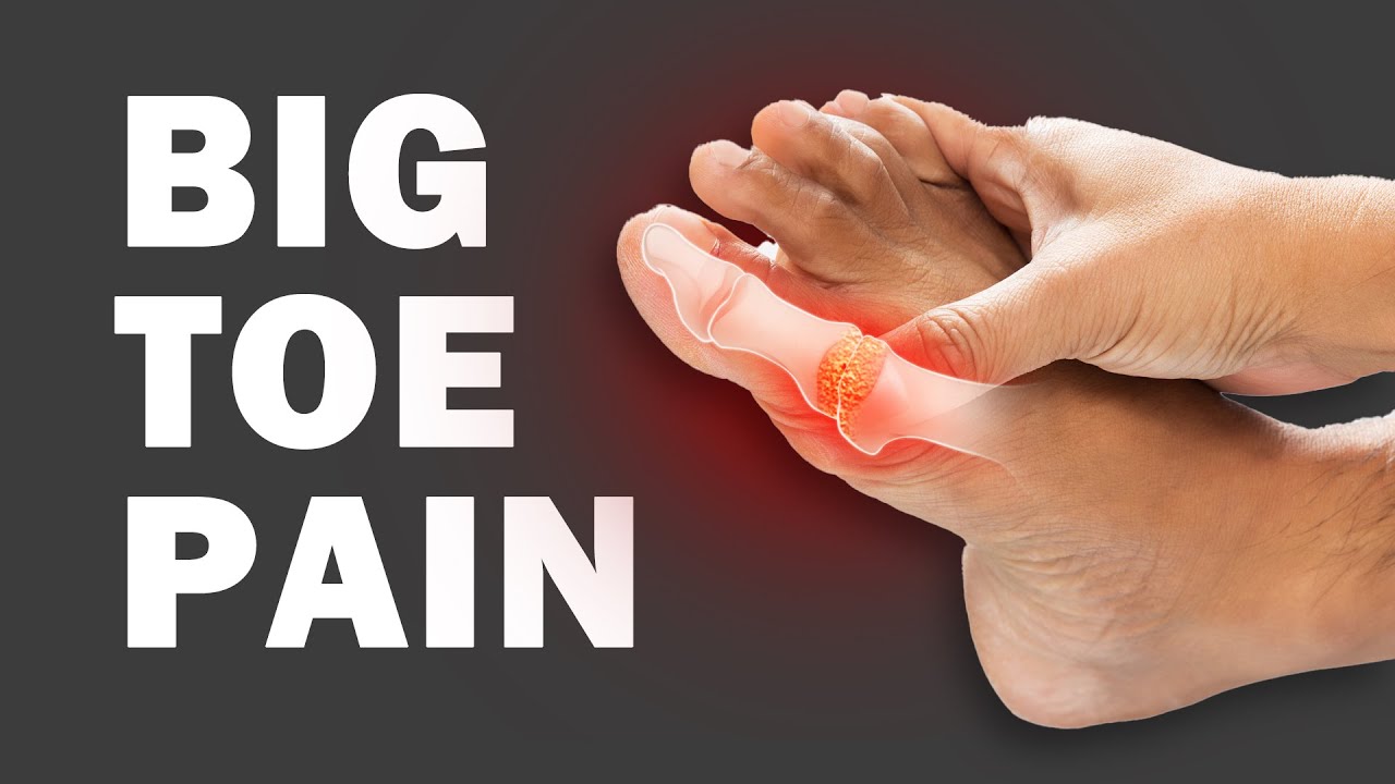 Understanding Gout // Causes, Triggers and Treatments YouTube