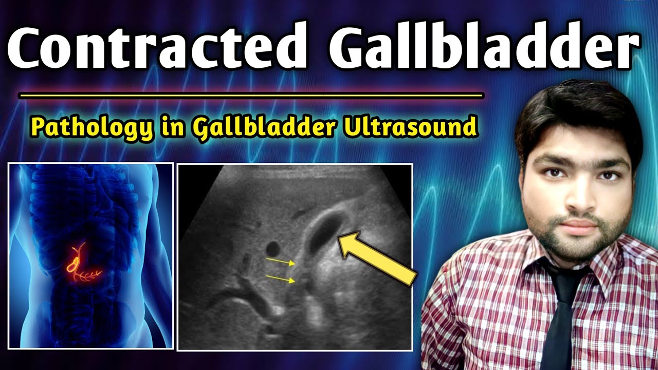 Case Study 1 Contracted Gallbladder Finding By Ali Waqar YouTube