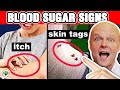 10 Alarming Signs Your Blood Sugar Is Too High