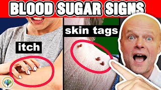 10 Alarming Signs Your Blood Sugar Is Too High screenshot 1