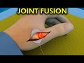 The Basics of Joint Fusion Surgery: Unveiling the Procedure with 3d animations