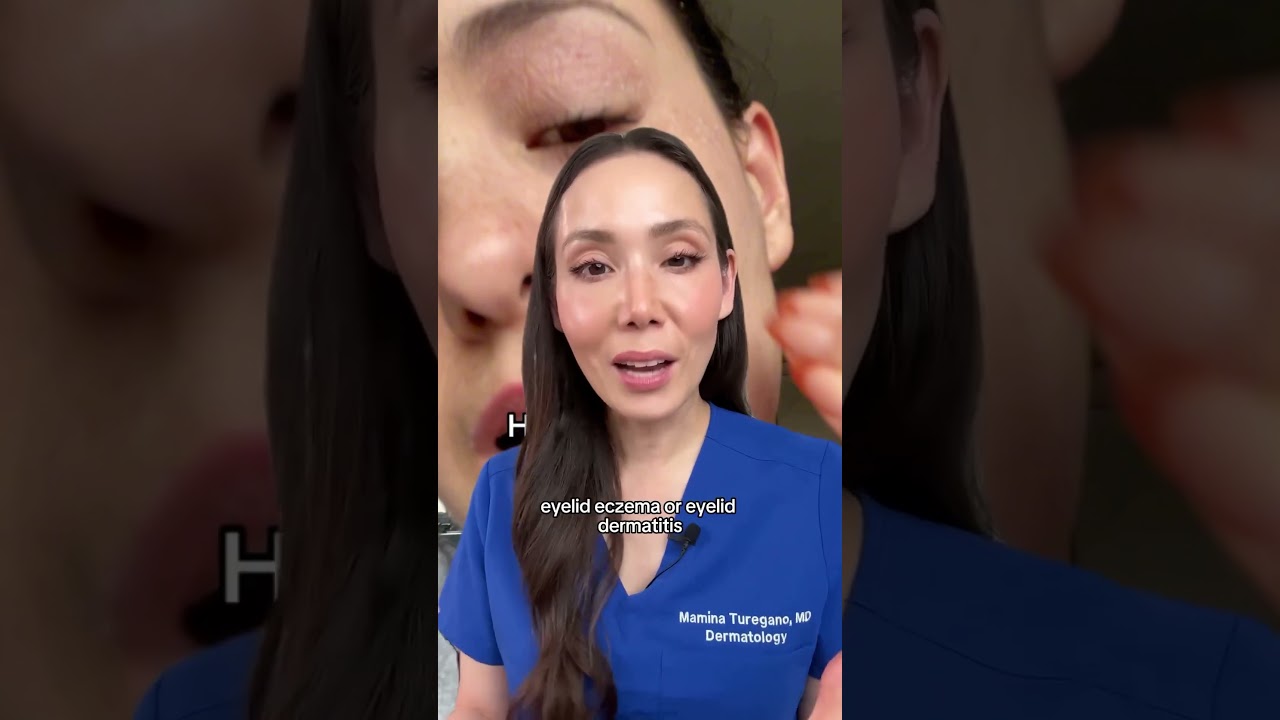 Eyelid Eczema: Part I