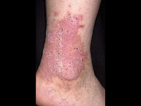 Dermatology: (Wk3)(Wed)(Spr20): Lichen Simplex Chronicus & Atopic Dermatitis
