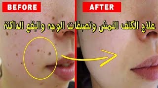 علاج ناجح للكلف النمش وتصبغات الوجه والبقع الداكنة لوجه صافي كالبدر روتين ناجح 100% والنتيجة مضمونة