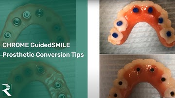 CHROME GuidedSMILE: Full Arch Prosthetic Conversion Tips