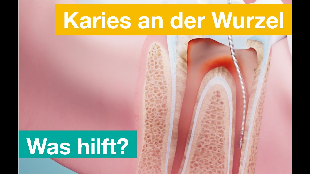 Wurzelkanalbehandlung verhindern / vermeiden - Muss es immer die Wurzelbehandlung sein?