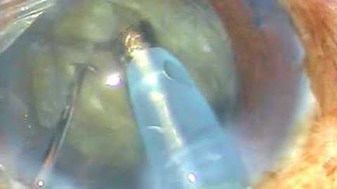 Phaco - The "stop and chop" technique of Nucleus Management
