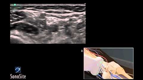 How To: Ultrasound Guided Popliteal Sciatic Nerve Block 3D Video
