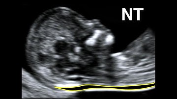 How to perform Nuchal Translucency Scan