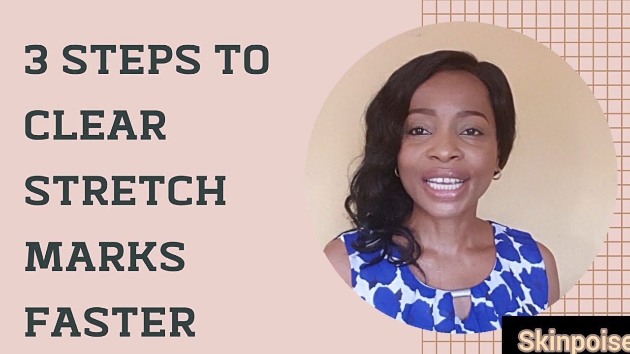 STRETCH MARKS? 3 STEPS TO CLEAR STRETCH MARKS FASTER YouTube
