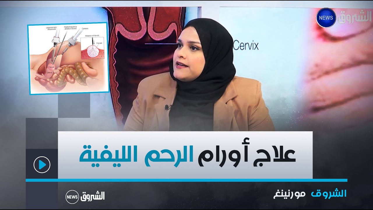 الشروق مورنينغ| الأورام الليفية الرحمية.. الأسباب، الأنواع و الأعراض، المضاعفات و العلاجات المتاحة