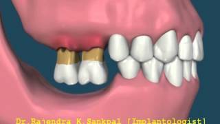 Not Replacing Posterior teeth